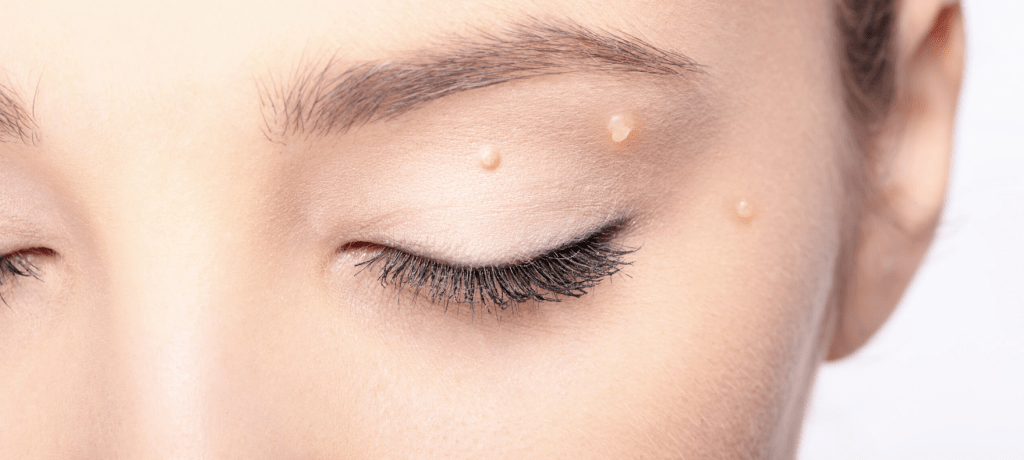 Molluskum Kontagiosum